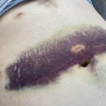 Signs You May Need Gallbladder Surgery
