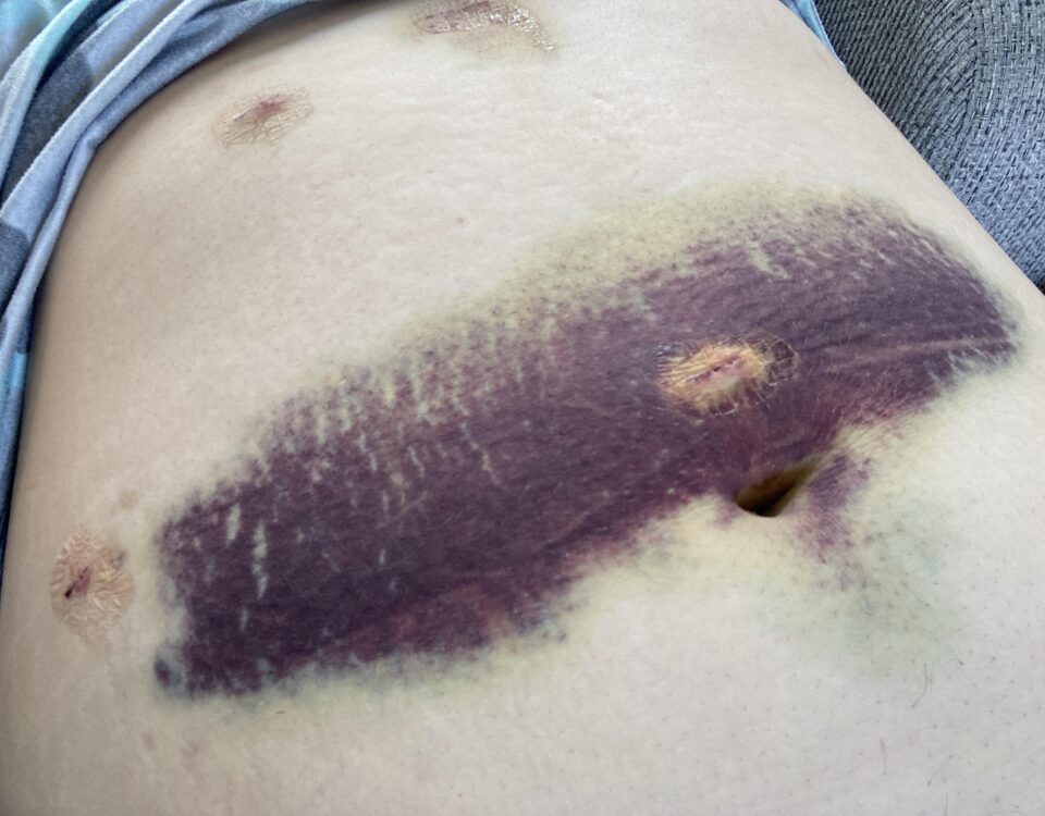 Signs You May Need Gallbladder Surgery