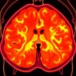 The Benefits of Early Detection in Prostate Cancer Treatment