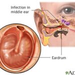 The Long-term Effects of Untreated Ear Infections