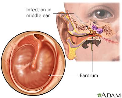 The Long-term Effects of Untreated Ear Infections