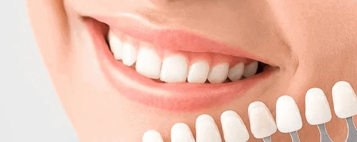 The Power of a Cosmetic Dentist in Smile Makeovers