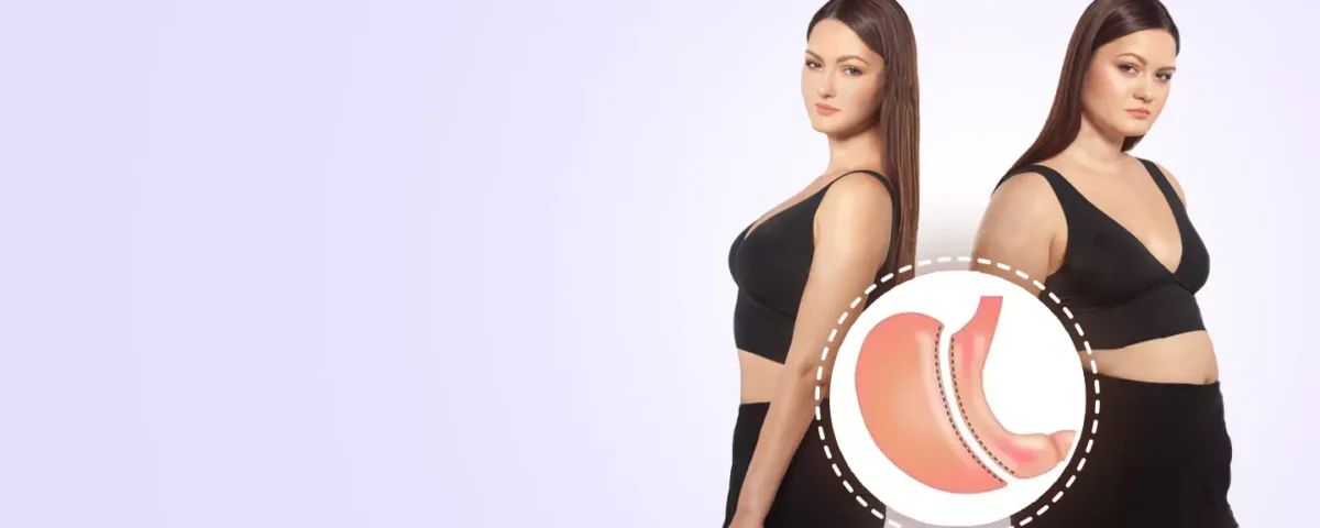 The Role of Gastric Sleeve Surgery in Weight Loss