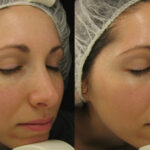 The Role of Hydro Facials in Your Skincare Routine
