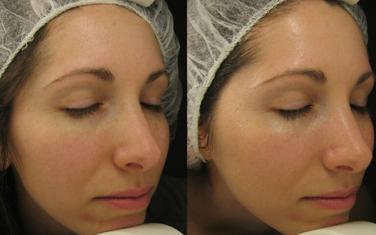 The Role of Hydro Facials in Your Skincare Routine