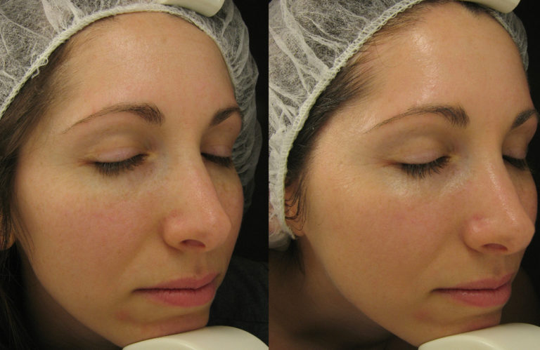 The Role of Hydro Facials in Your Skincare Routine
