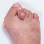 Understanding Bunion Causes, Symptoms, and Treatment Options