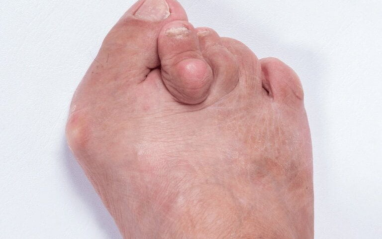 Understanding Bunion Causes, Symptoms, and Treatment Options