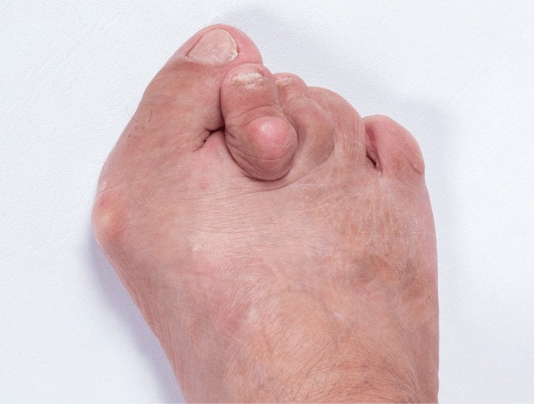 Understanding Bunion Causes, Symptoms, and Treatment Options