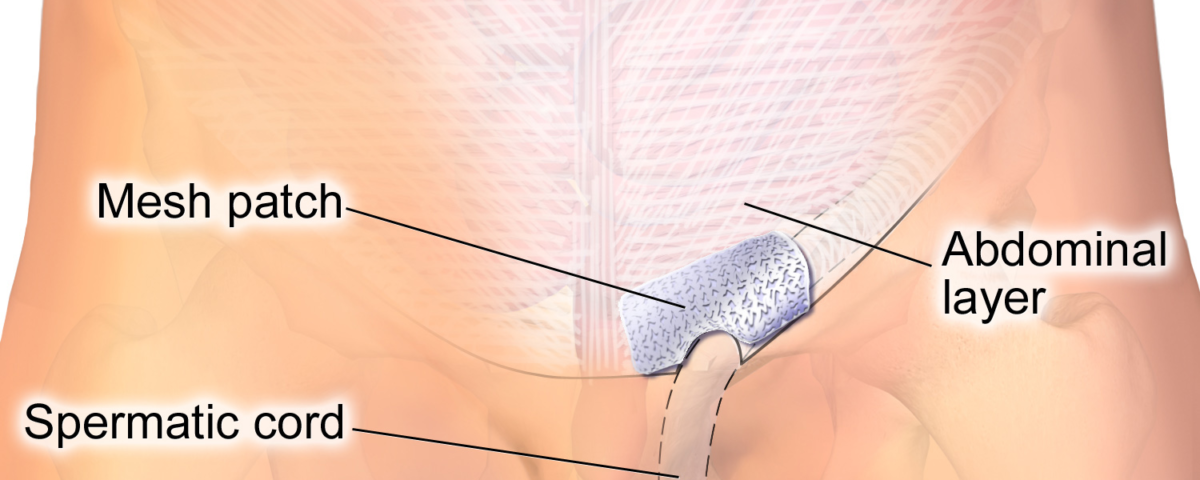 What To Expect Before and After Hernia Repair Surgery