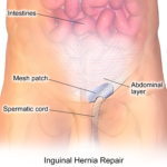 What To Expect Before and After Hernia Repair Surgery