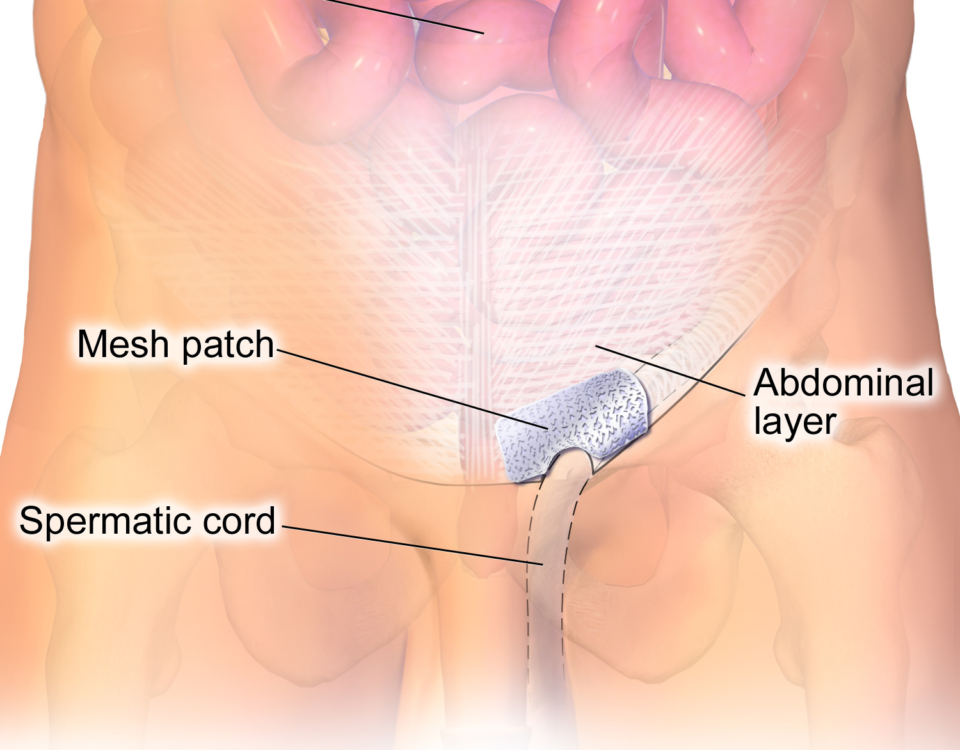 What To Expect Before and After Hernia Repair Surgery