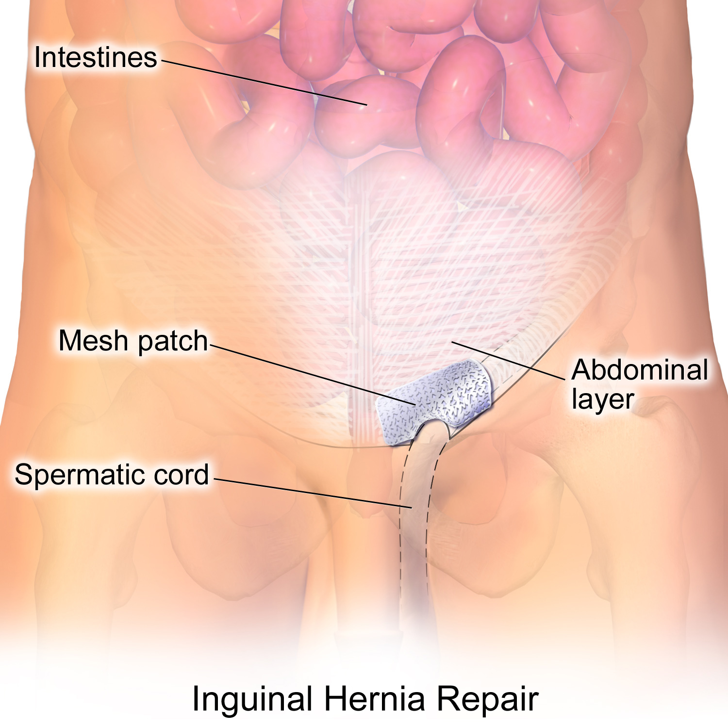 What To Expect Before and After Hernia Repair Surgery