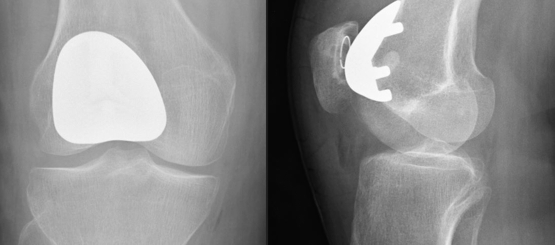 What to Expect During Knee Replacement Surgery