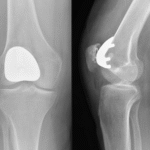 What to Expect During Knee Replacement Surgery