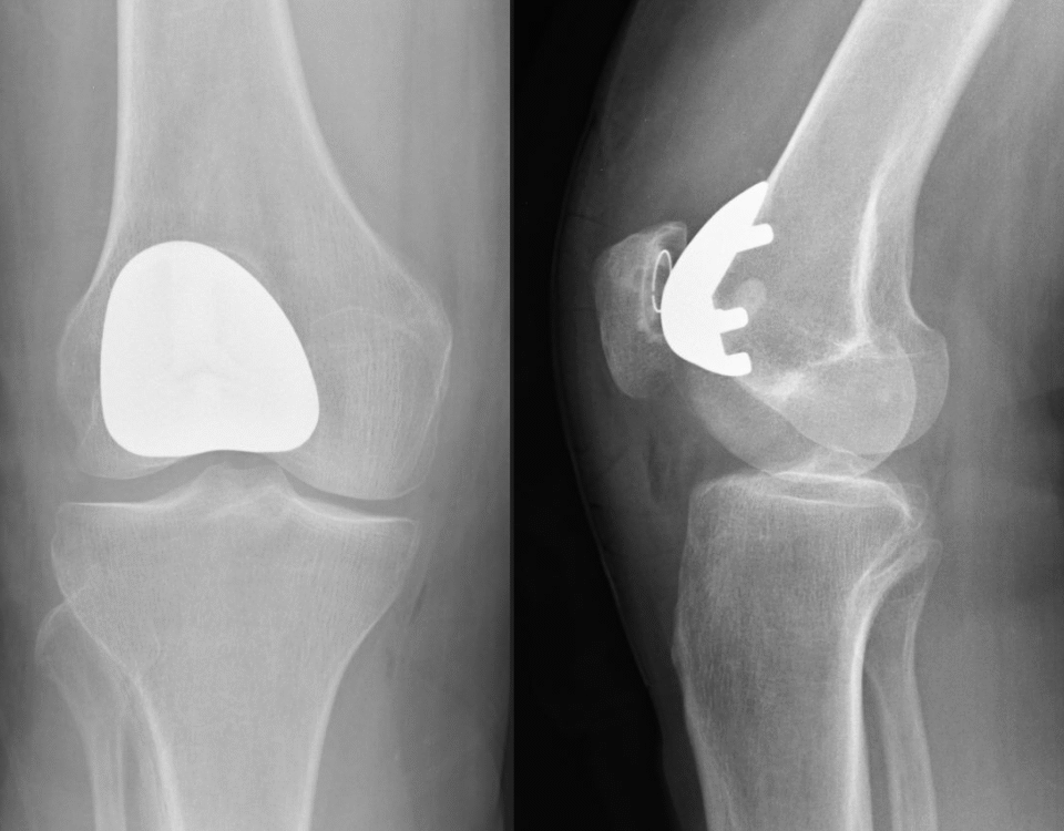 What to Expect During Knee Replacement Surgery