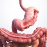 Pelvic Floor Dysfunction and Its Impact on Daily Life