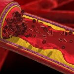 What to Expect When Getting Treated for Coronary Artery Disease