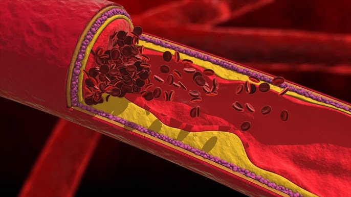 What to Expect When Getting Treated for Coronary Artery Disease