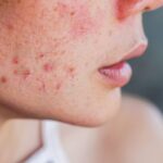 When To See a Dermatologist for Acne