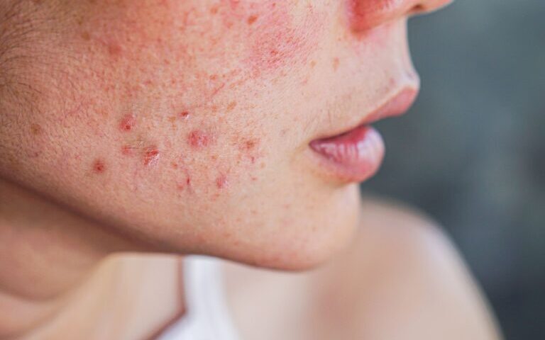 When To See a Dermatologist for Acne