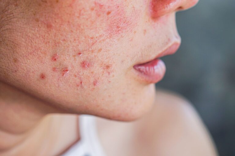 When To See a Dermatologist for Acne