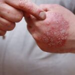 Approaches To Psoriasis Treatment for Skin Health