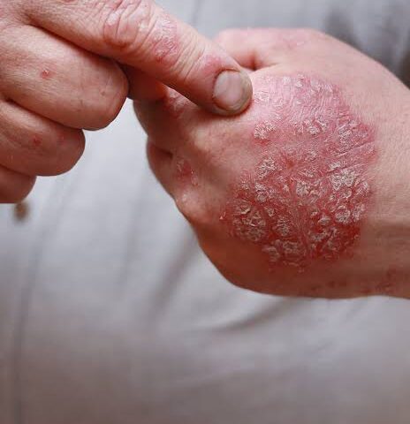 Approaches To Psoriasis Treatment for Skin Health