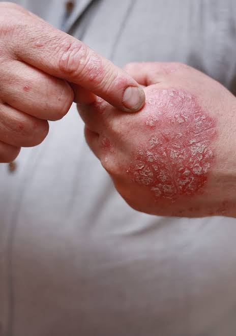 Approaches To Psoriasis Treatment for Skin Health