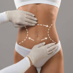 Body Contouring for Every Body Type