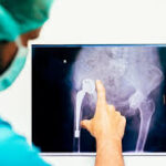 Effective Care Techniques for Hip Replacement Patients