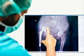 Effective Care Techniques for Hip Replacement Patients