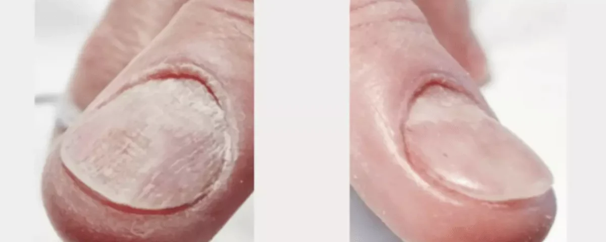 How Dermatologists Treat Common Nail Disorders