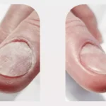 How Dermatologists Treat Common Nail Disorders