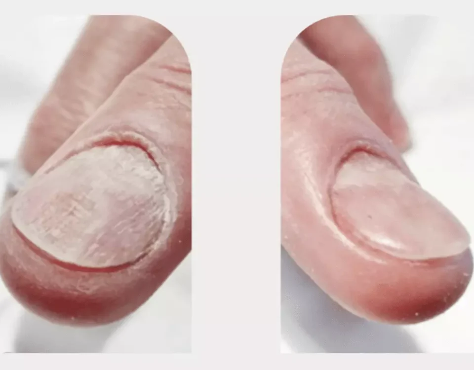 How Dermatologists Treat Common Nail Disorders