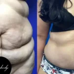 Navigating Tummy Tuck Recovery Steps