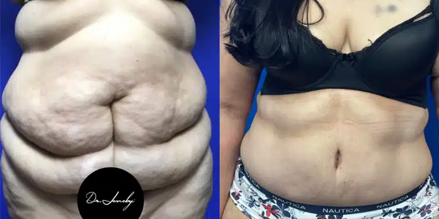 Navigating Tummy Tuck Recovery Steps