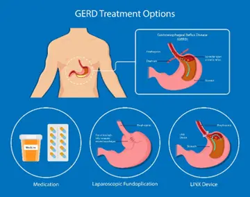 The Impact of Reflux Disease on Daily Life