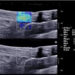 Understanding the Differences Between Ultrasound and MRI in Diagnosing Sports Injuries