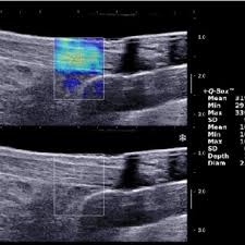 Understanding the Differences Between Ultrasound and MRI in Diagnosing Sports Injuries