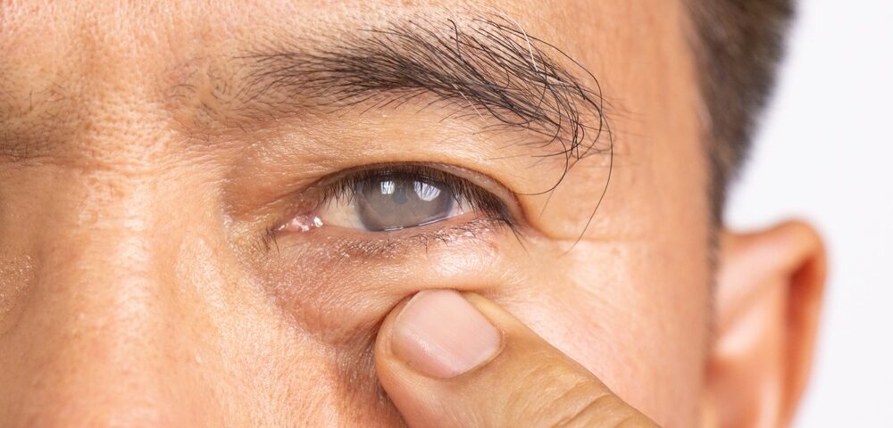 What to Expect During Cataract Surgery