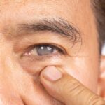 What to Expect During Cataract Surgery