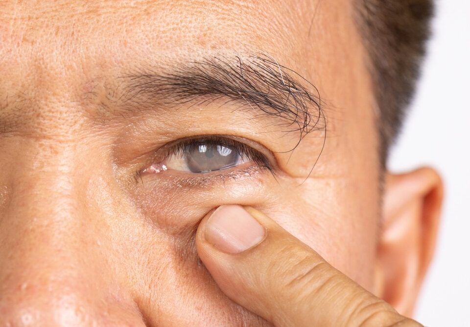 What to Expect During Cataract Surgery