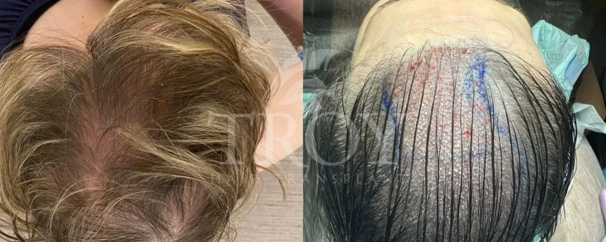 Comparing PRP for Hair Loss to Other Treatments