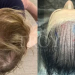 Comparing PRP for Hair Loss to Other Treatments