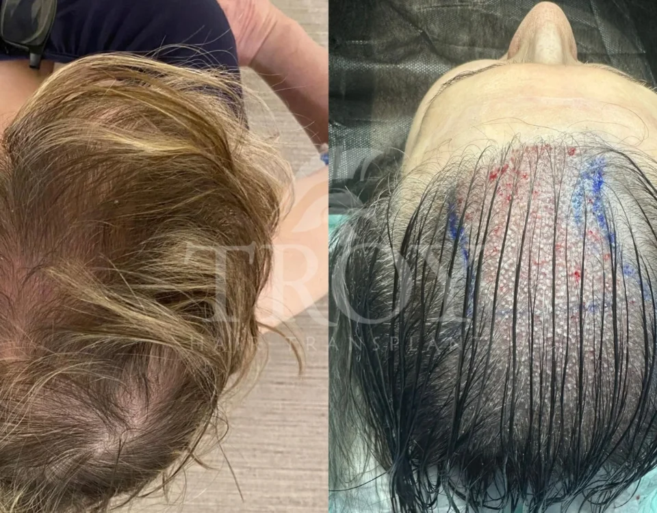 Comparing PRP for Hair Loss to Other Treatments