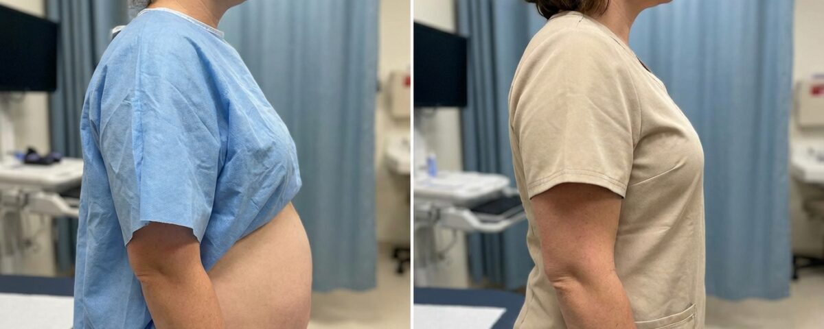 Exploring the Benefits of Liposuction for Body Contouring