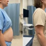 Exploring the Benefits of Liposuction for Body Contouring