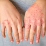 How to Choose a Dermatologist for Your Skin Needs