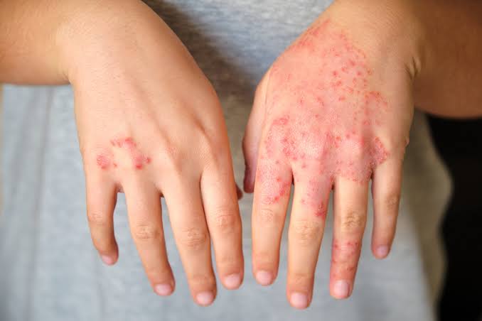How to Choose a Dermatologist for Your Skin Needs